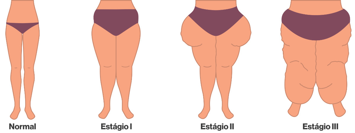 Estádios-do-Lipedema-site